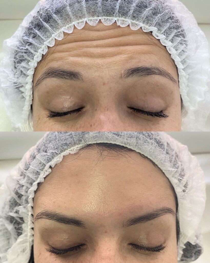 Botox